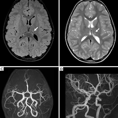 Head Ct Brain Mri And Mr Angiography Mra At Clinical Onset A