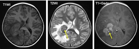 Choroid Plexus Carcinoma Radiology Cases