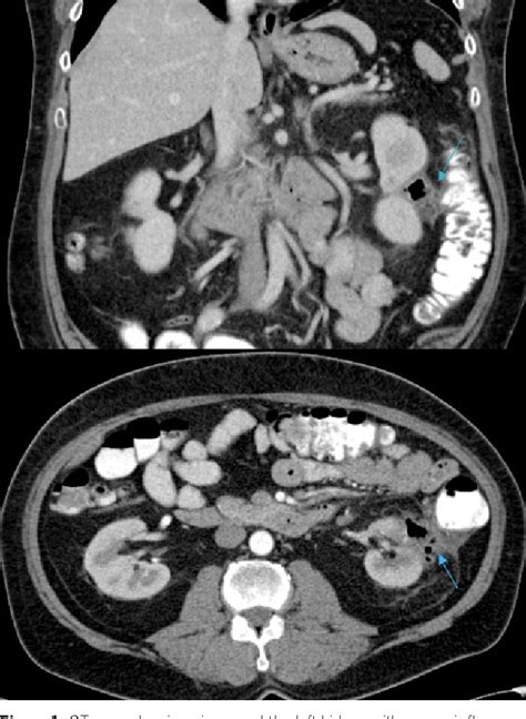 Figure 1 From A Rare Case Of Nephrocolic Fistula Resulting From Radio