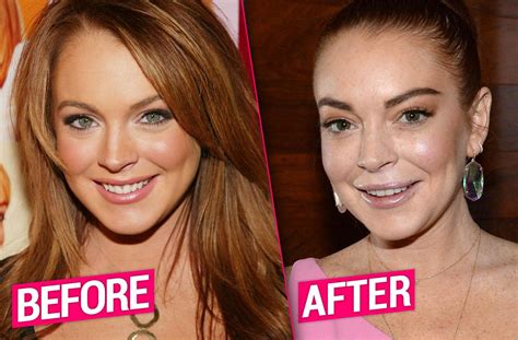 Lindsay Lohans Plastic Surgery Makeover Exposed By Top Docs