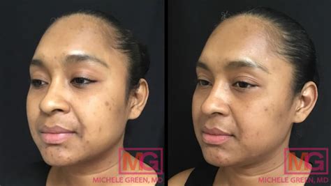 Acne Scar Discoloration Treatment Dr Michele Green Md