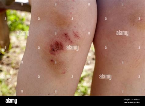 Child Scraped Knee Fotografías E Imágenes De Alta Resolución Alamy