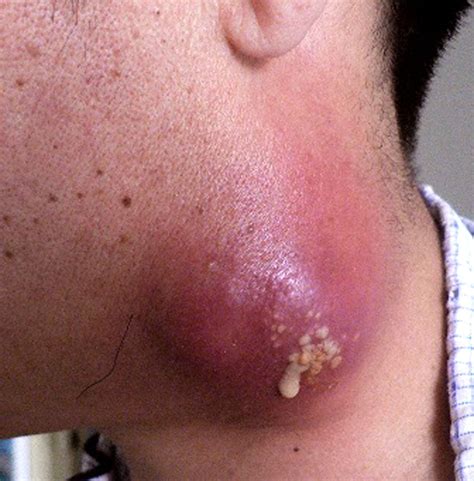 Acute Paradoxical Reaction Of Cervical Tuberculous Lymphadenitis
