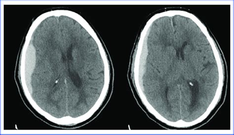 Ct Scan Showing An Acute Subdural Hematoma With Mass Effect And Midline Download Scientific