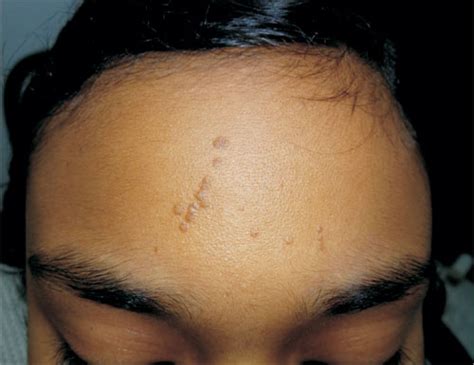 Papules On Forehead