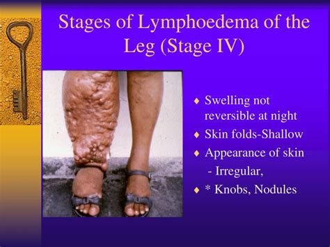 Ppt Lymphatic Filariasis Powerpoint Presentation Free Download Id