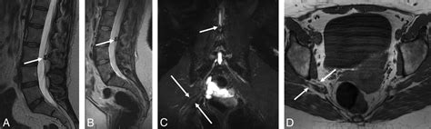 Impact Of Mr Neurography In Patients With Chronic Cauda Equina Syndrome