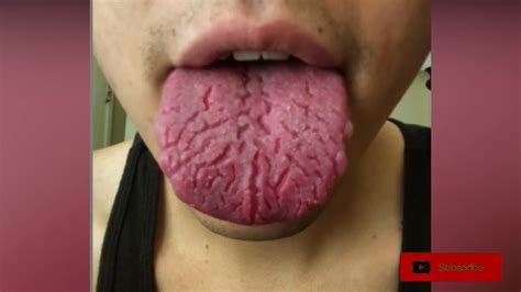 Fissured Tongues How Does This Happen Youtube