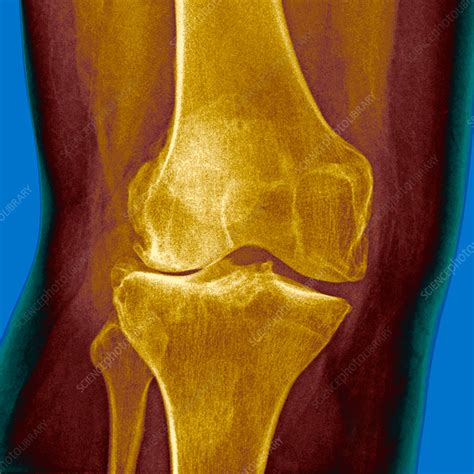 Knee In Osteoarthritis X Ray Stock Image C0302155 Science Photo