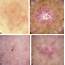 Basal Cell Carcinoma  Journal Of The American Academy Dermatology