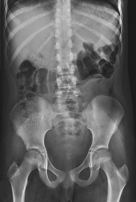 Severe Constipation X Ray