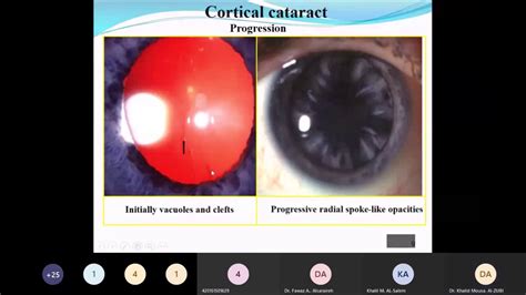Cataract Lecture Of Dr Khaled Al Zubi Youtube