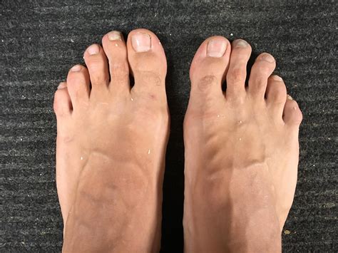 Recurring Thick Patch On My Sole Foot Mechanics Issue Barefootrunning