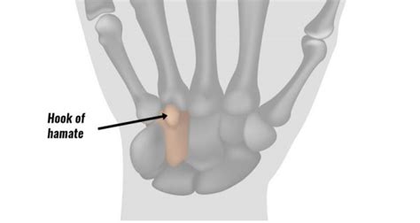 Hook Of Hamate Fracture Symptoms Causes And Treatment