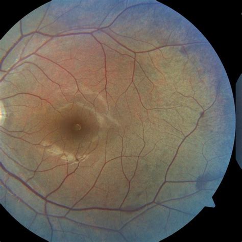 A The Left Fundus Achieved Near Normal Color After Long Dark