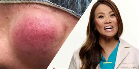 Pimple popper premiered on thursday. Dr. Pimple Popper Squeezes Cyst That Looks Like 'Lump Of ...