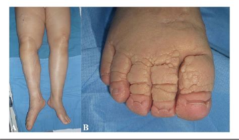 Successful Surgical Treatment For Elephantiasis Nostras Verrucosa Using
