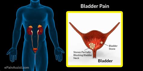 Bladder Pain Pathophysiology Etiology Risk Factors Signs Symptoms Treatment