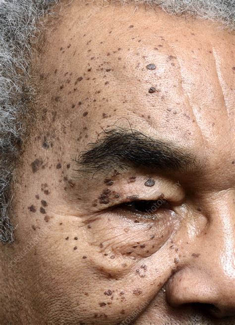 Dpn Skin Lesions On The Face Stock Image C0156130 Science Photo