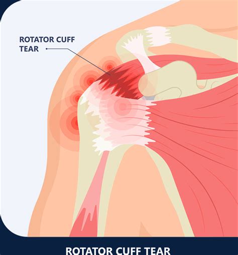 Rotator Cuff Tear Treatment In Singapore Quantum Orthopaedics