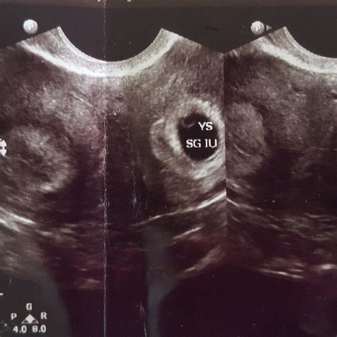 2d ultrasound image of a bicornuate uterus with an intra uterine download scientific diagram