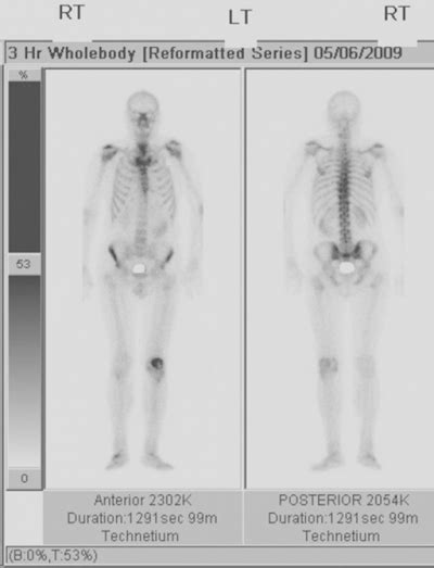 Bone Density Scan Kymera Independent Physicians