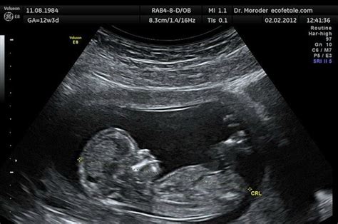 A Guide On How To Tell Baby Gender From Ultrasound Picture
