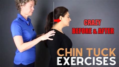 Chin Tuck Exercise Before And After Text Neck Youtube