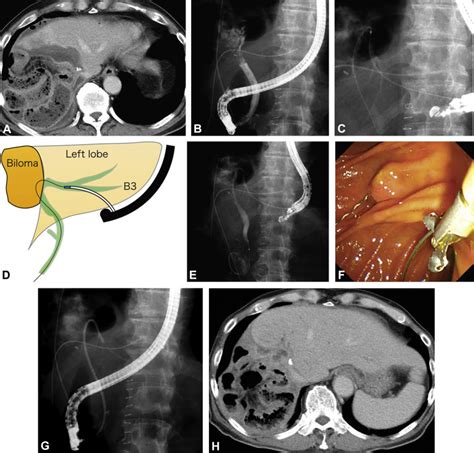 Eus Guided Rendezvous Technique For Refractory Benign Biliary Stricture Caused By Postoperative