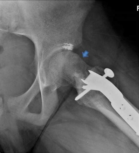 Surgical Dislocation And Proximal Femoral Osteotomy For A 12 Year Old