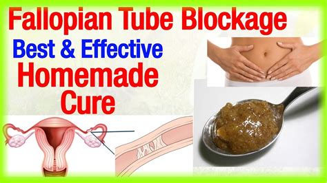Natural Treatment For Blocked Fallopian Tubes