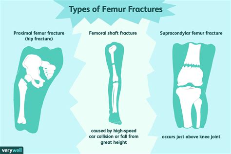 Intramedullary Nail Femur Physical Therapy Protocol Nail Ftempo
