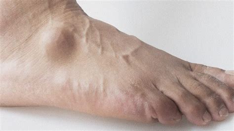 What Causes A Ganglion Cyst On Your Foot And Ankle Podiatry Hotline