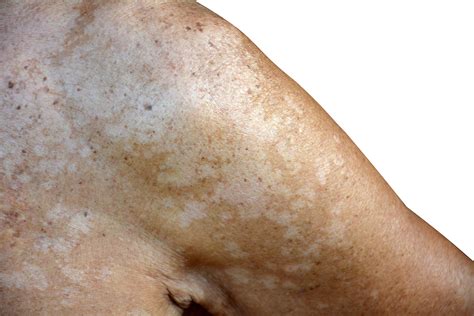 Diagnosing Managing Hypopigmented Skin Disorders Dermatology Times
