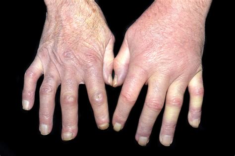 researchers evaluated the efficacy of rituximab in treating systemic sclerosis