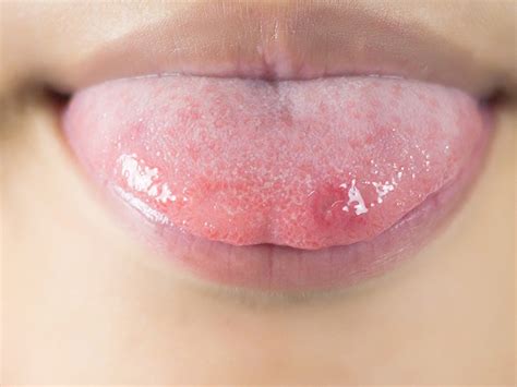 Black Spots On Tongue Causes Prevention Tips And Home