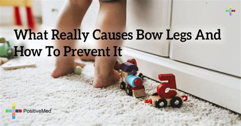 What Really Causes Bow Legs