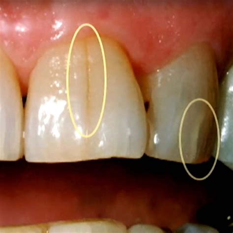 Tooth Fracturecracked Tooth Causes Diagnosis And Treatments
