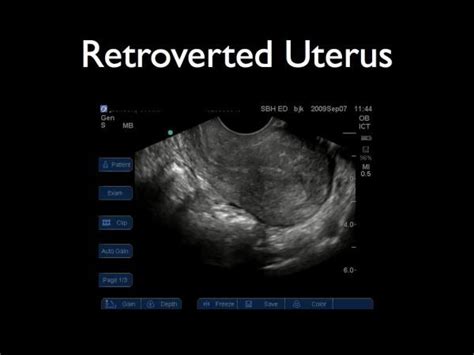 retroverted uterus ultrasound my xxx hot girl