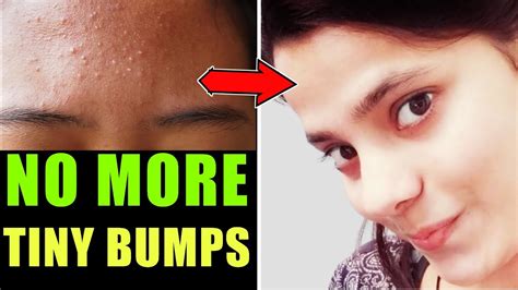7 Days Challenge Treat Tiny Bumps On Face Naturally At Home 100