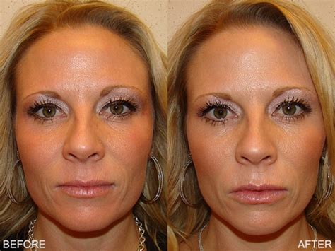 Omaha Cosmetic Surgery Restylane Filler Treatment Schlessinger Md