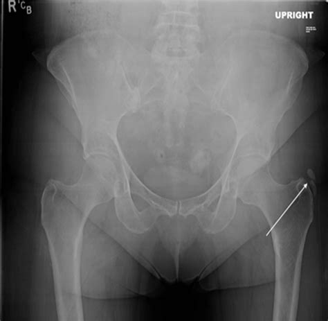Calcific Tendonitis Of The Left Hip Arrow Seen On The Anterior Hot