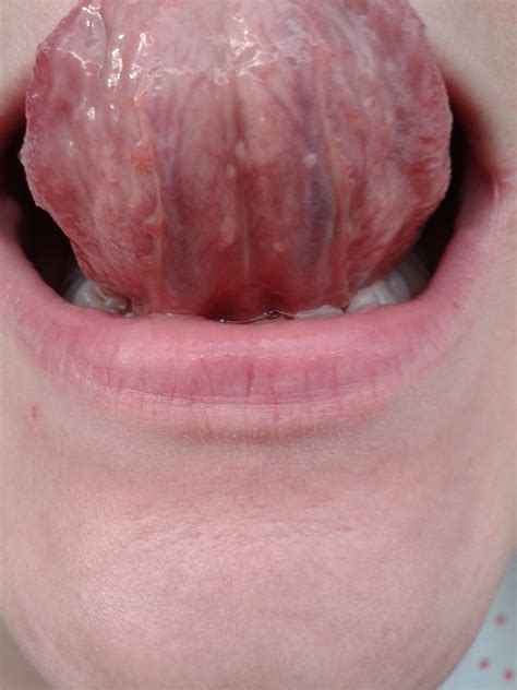 I Have Recently Noticed Some Bumps On The Underside Of My Tongue