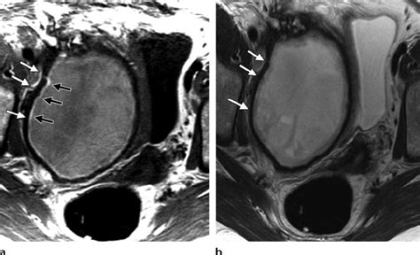 Hematoma In A 56 Year Old Woman With A Lower Pelvic Mass A Axial T1