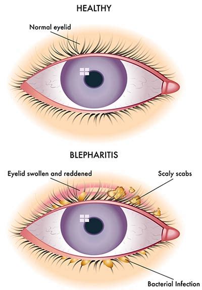 Itchy Eyelids Blepharitis Treatment · Top Eye Doctors Specialists In Nyc