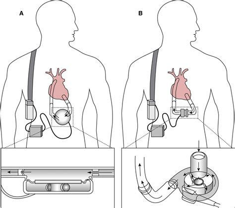 Mechanical Circulatory Support In The Treatment Of Advanced Heart