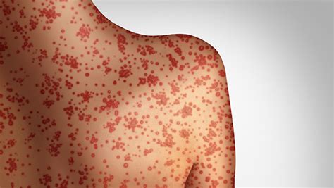 Increase In Measles Cases — United States January 1april
