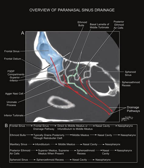 Overview Of The Drainage Pathways Of The Paranasal Sinuses A