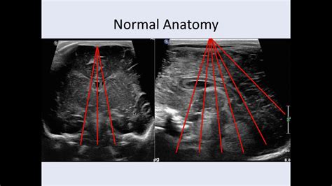 Cranial Ultrasound Anatomy Youtube