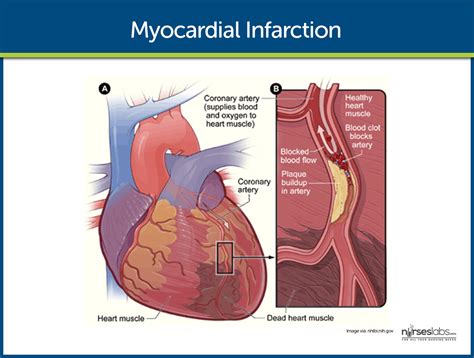 Nursing Case Study Myocardial Infarction